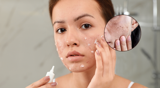 How hyperpigmentation occurs 'Dark Spots'